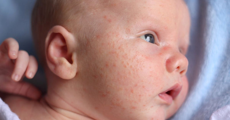 Baby acne covers an infant's face.