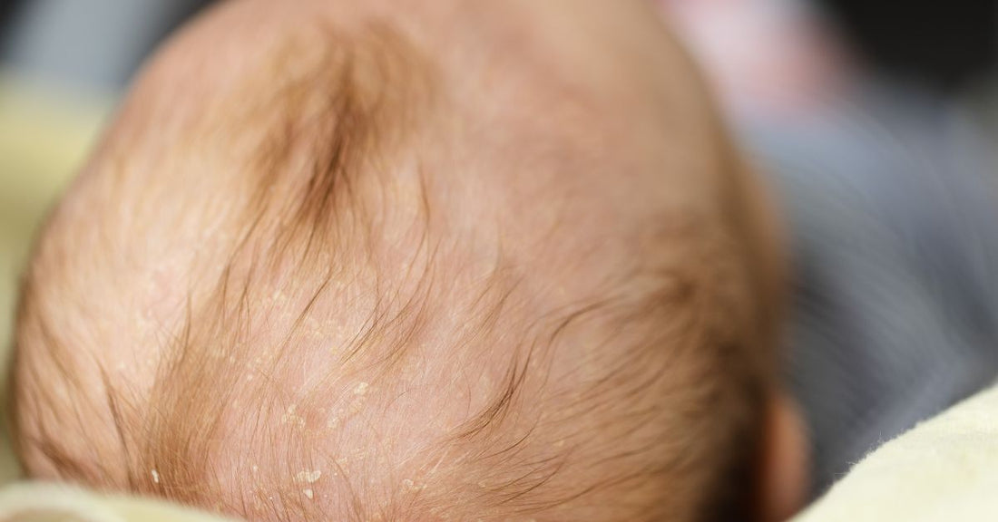 A baby's scalp with cradle cap.