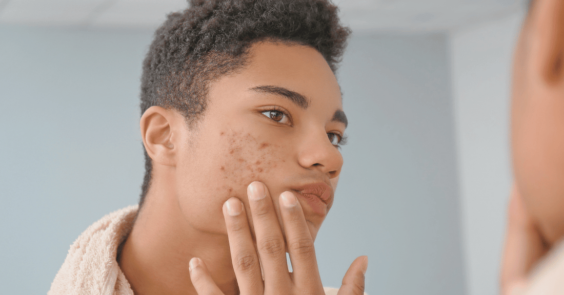 A teen boy looks at the acne on his face.